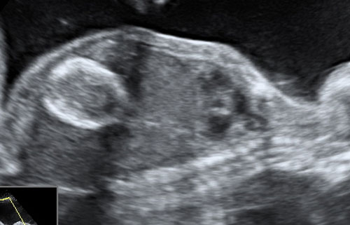 polyhydramnios ultrasound
